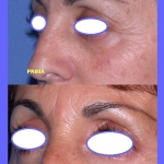 Blefaroplastica Prima e Dopo