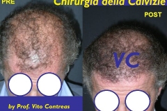chirurgia_calvizie