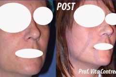 facelift_roma_cagliari