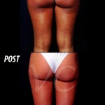 Liposuzione Prima e Dopo