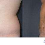 Liposuzione Prima e Dopo