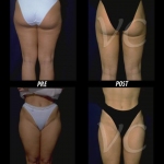 Liposuzione Prima e Dopo