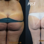 Liposuzione Prima e Dopo