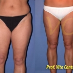 Liposuzione Prima e Dopo