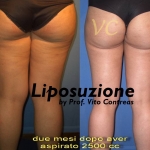 Liposuzione Prima e Dopo