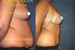 lipoplastica_mastoplastica_roma