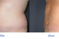 liposuzione_addominoplastica_roma_pre_post1