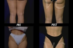 liposuzione_chirurgia_roma