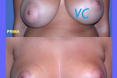 mastopessi_pre_post_roma