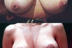 mastoplastica_riduttiva_BIG