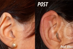 otoplastica_chirurgia_roma