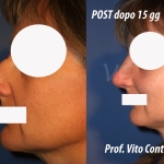 Foto Rinoplastica prima dopo