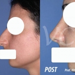 Rinoplastica prima e dopo