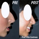Foto Rinoplastica prima e dopo