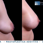 contreas mastoplastica