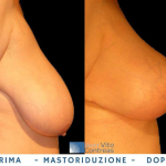 mastoplastica additiva