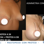 mastopessi-con-protesi-12