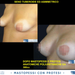 mastopessi-con-protesi-13