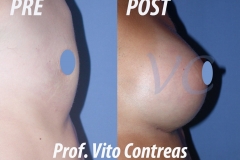 Mastoplastica Additiva