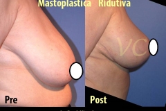 Mastoplastica Riduttiva prima e dopo