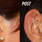 Otoplastica Chirurgia Orecchio