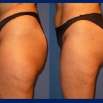 lipofilling_gluteo
