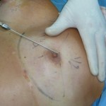 lipofilling_mammella