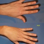 lipofilling_mani