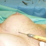 lipofilling_seno