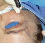 lipofilling_volto_viso