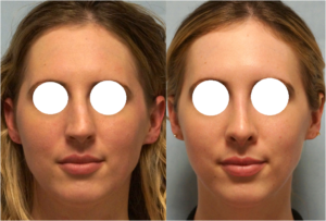 Rinosettoplastica Naso Rotto