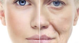 Ringiovanimento Viso Senza Bisturi