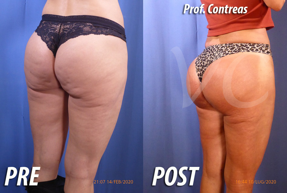 Gluteoplastica